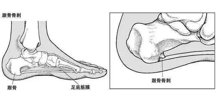 骨刺不是病？切勿過(guò)度治療！