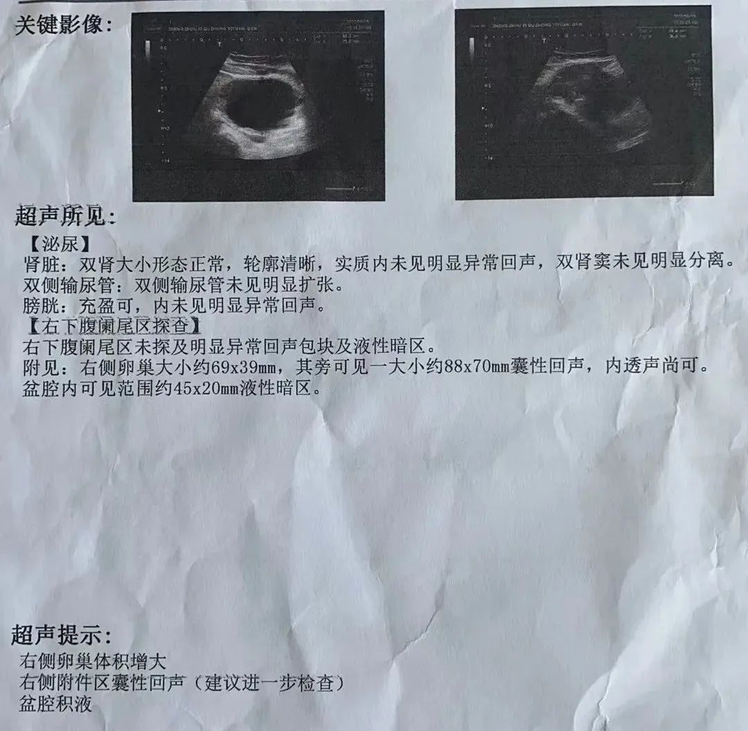 11歲女孩急性腹痛！竟然是卵巢囊腫蒂扭轉(zhuǎn)了